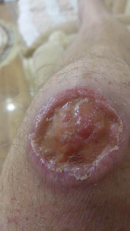 болезнь Рейтера