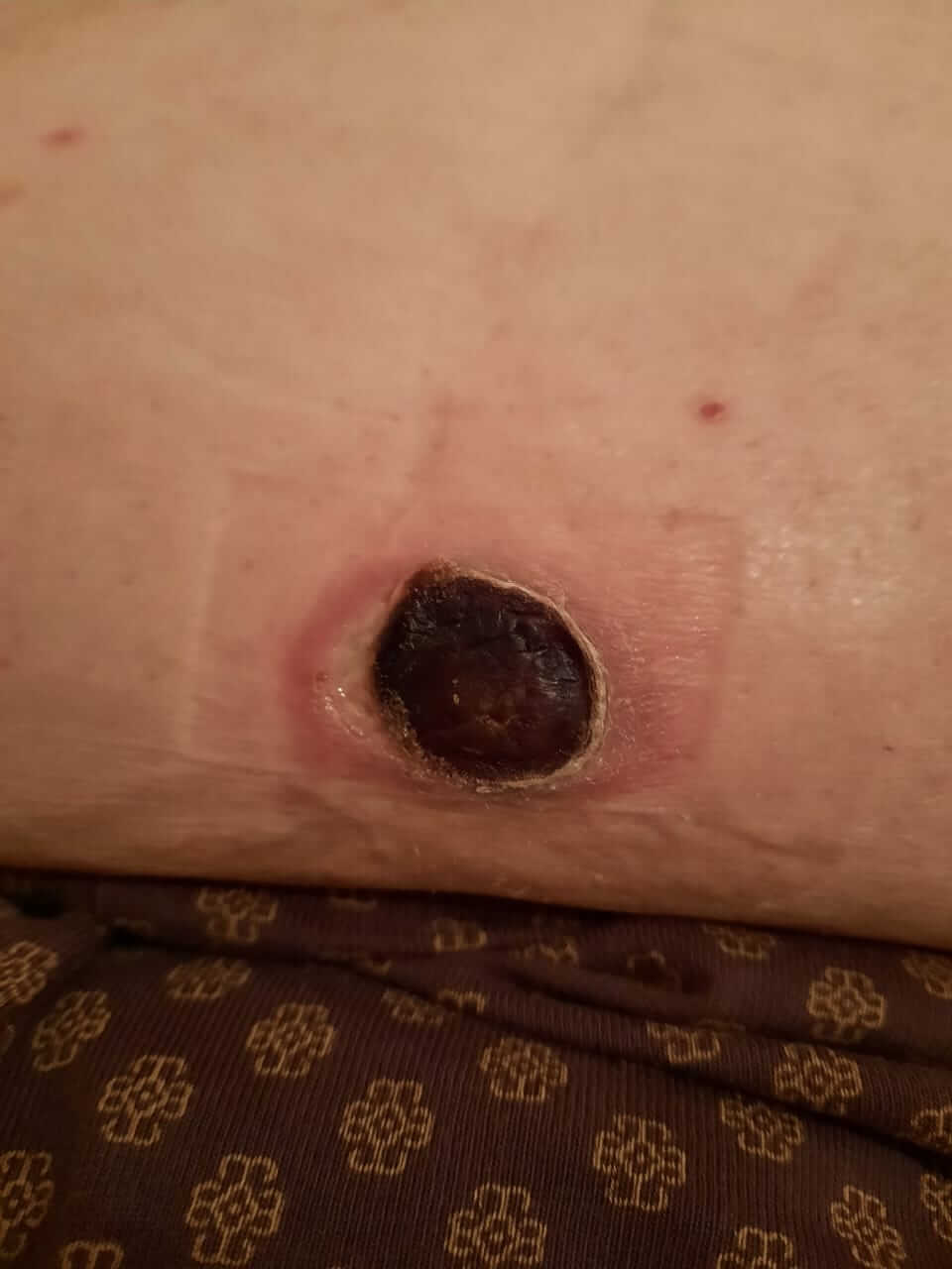 третичный сифилис язвенная пиодермия