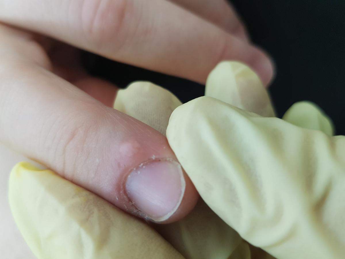 лечение бородавок на пальцах кистей до удаления