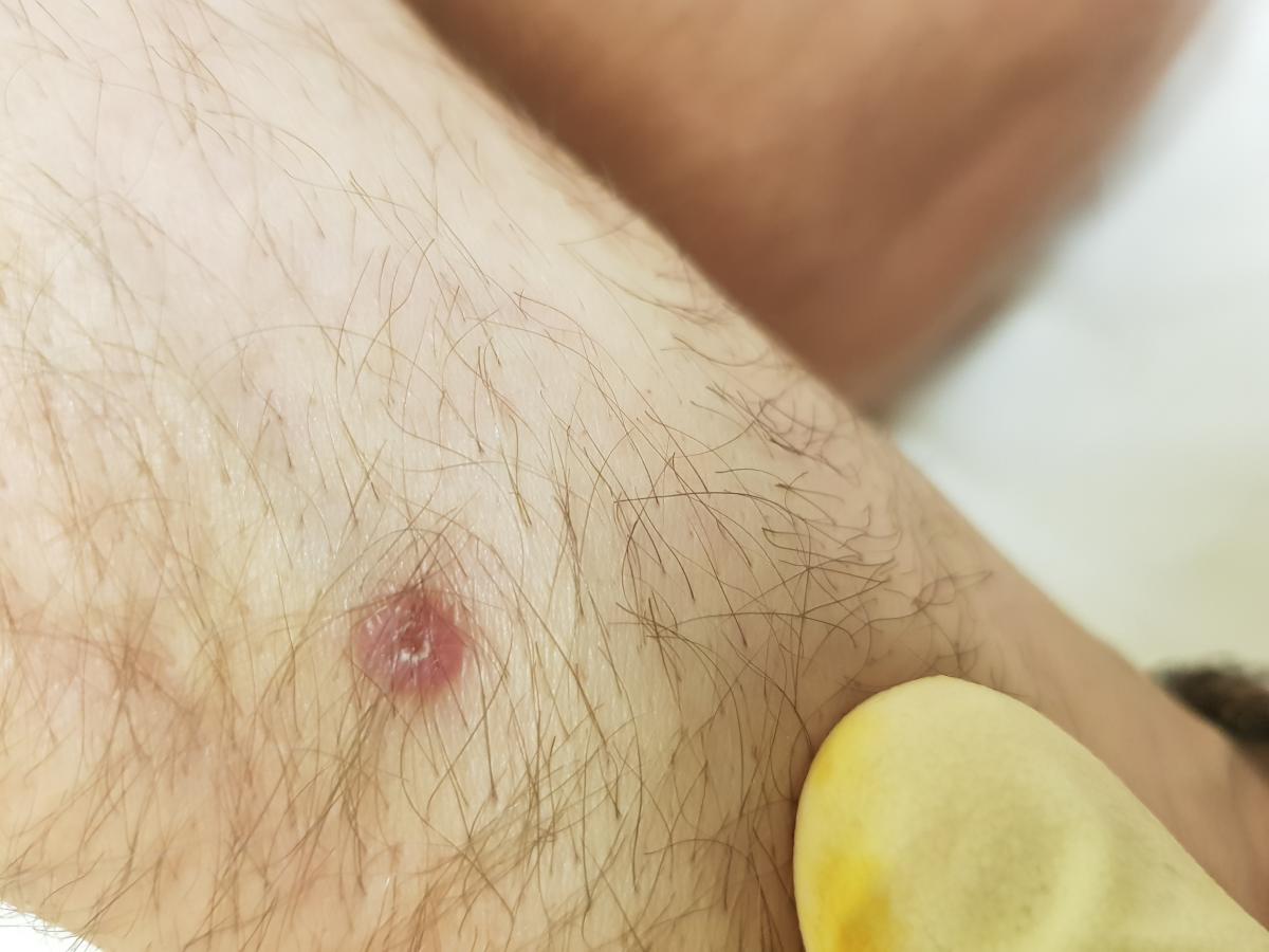 удаление рубца