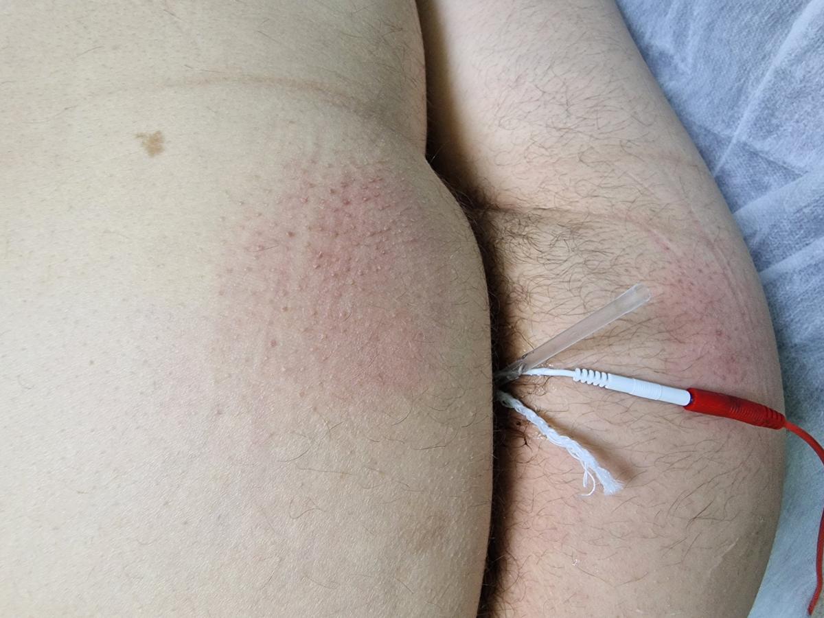 электрофорез на сосуды на головке члена и боли электрофорез