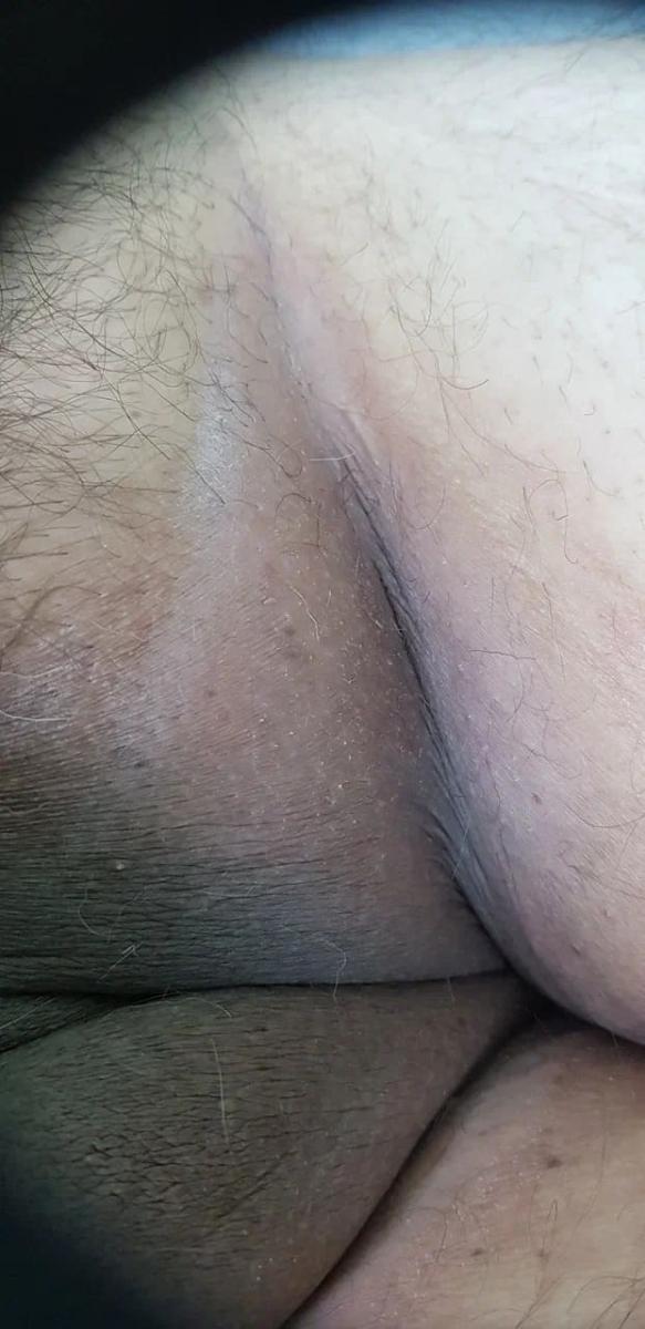 Паховая эритразма