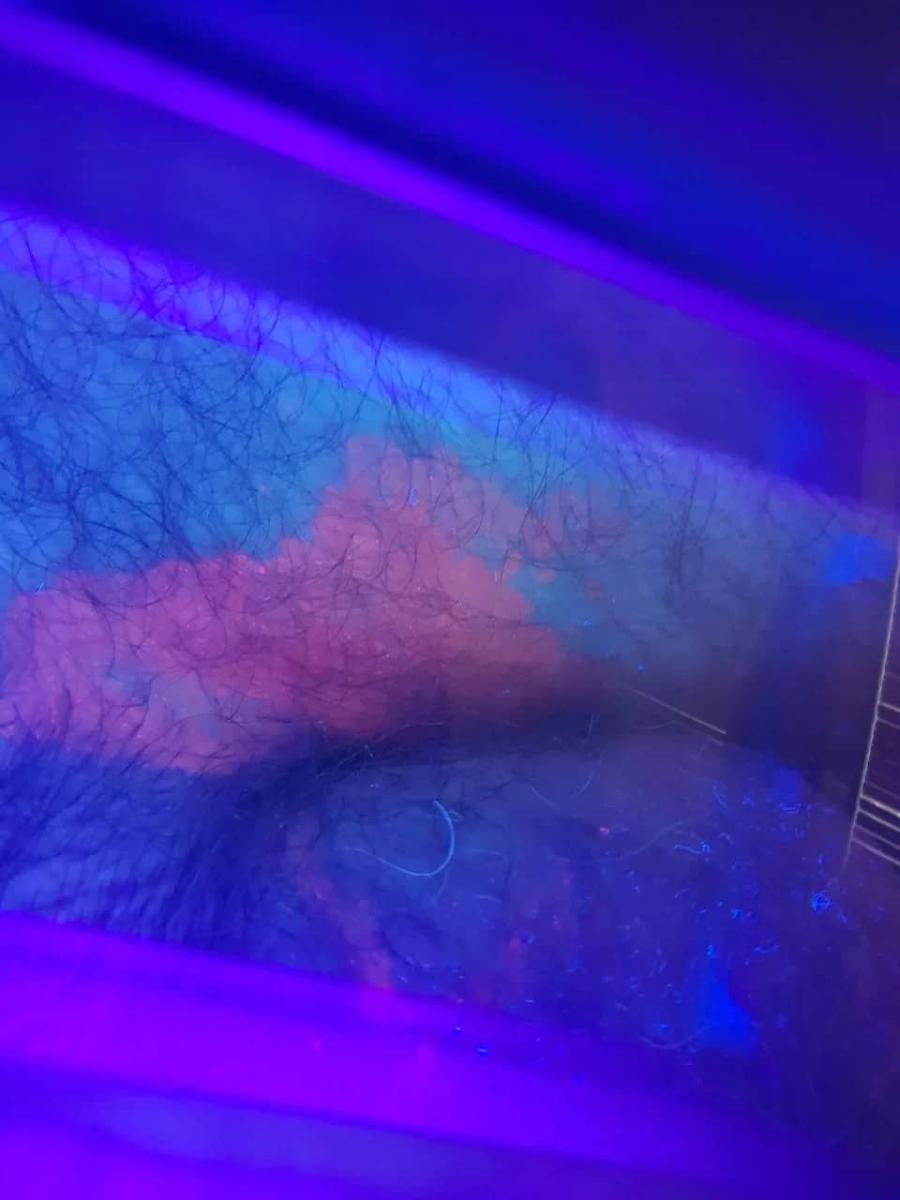 Эритразма при лечении под лампой