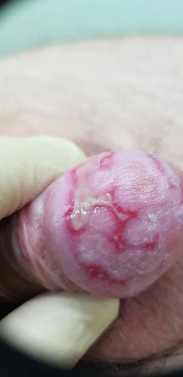 Красный плоский лишай