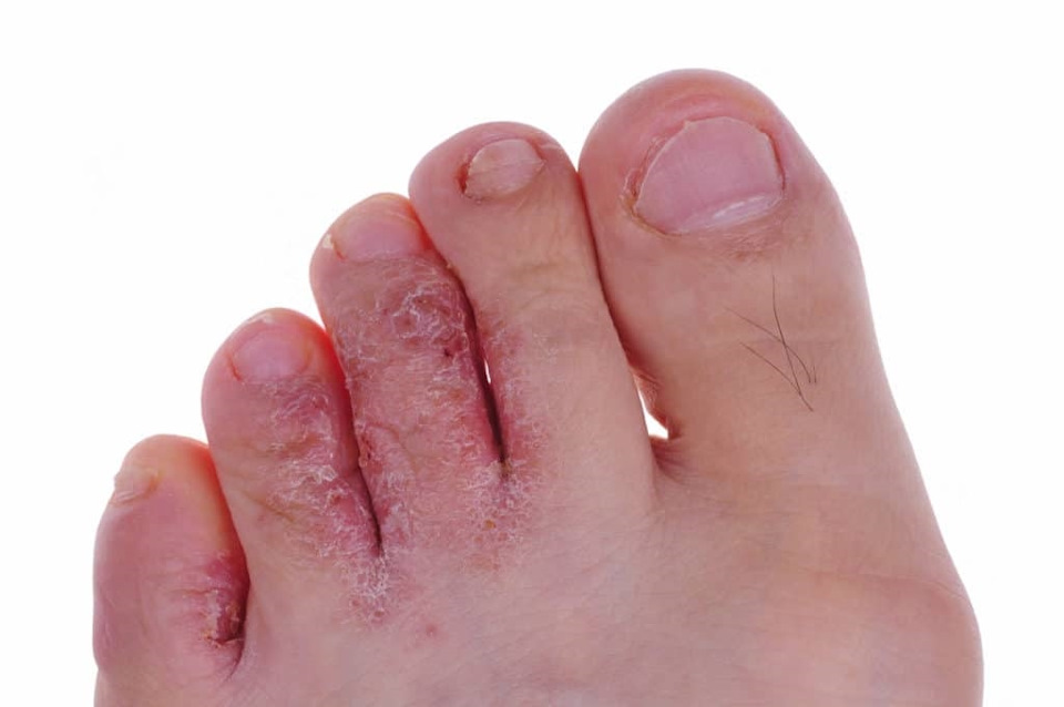 признаки грибка ногтей и кожи стоп
