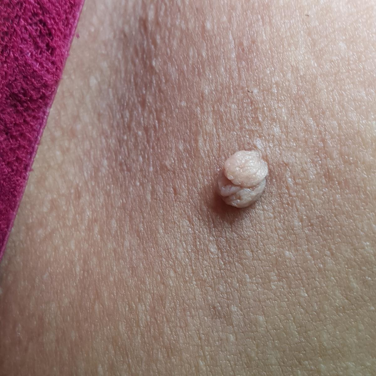 фибропапиллома