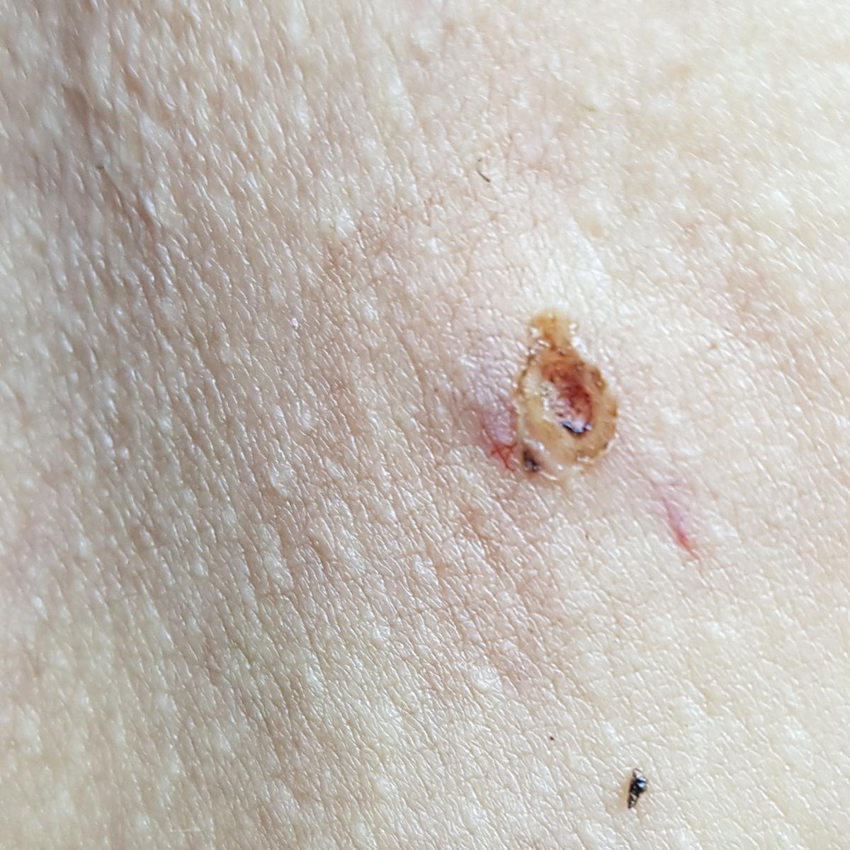 фибропапиллома после удаления