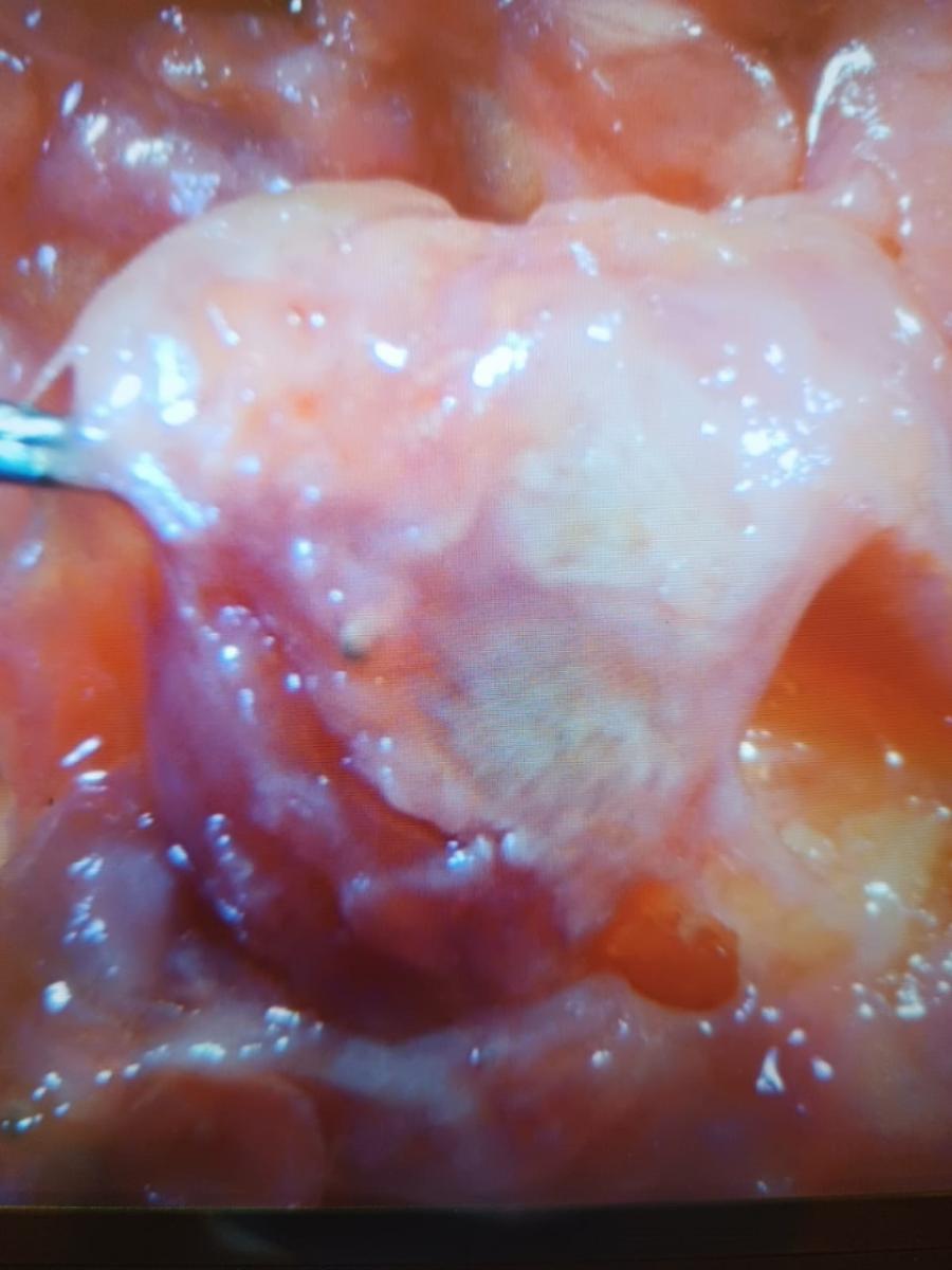 воспаление простаты при уреаплазме