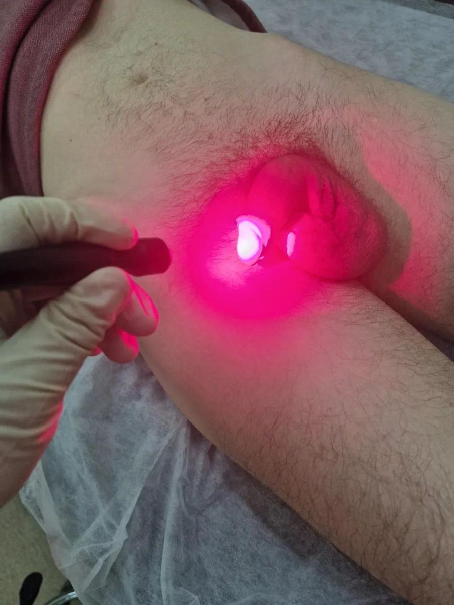 Фотодинамическая терапия уретры Фотодинамическая терапия уретры