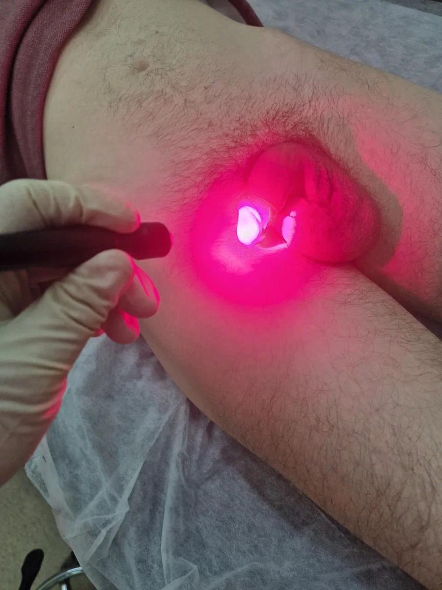 Фотодинамическая терапия уретры