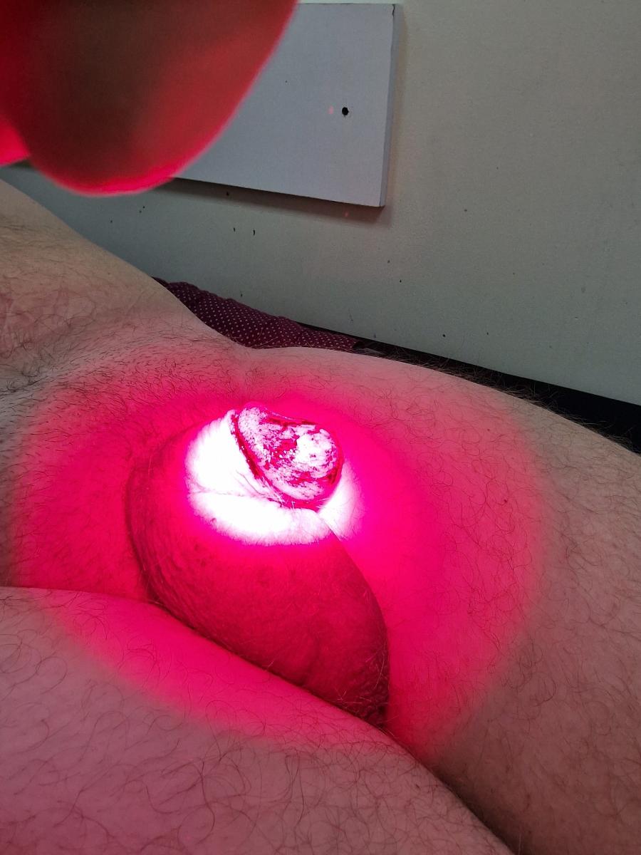 фотодинамический лазер фотодинамика