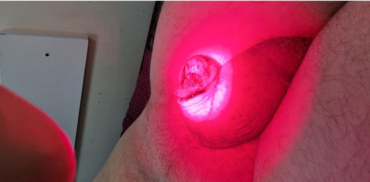 фотодинамическая терапия при белой сетке на головке и плоти фотодинамика