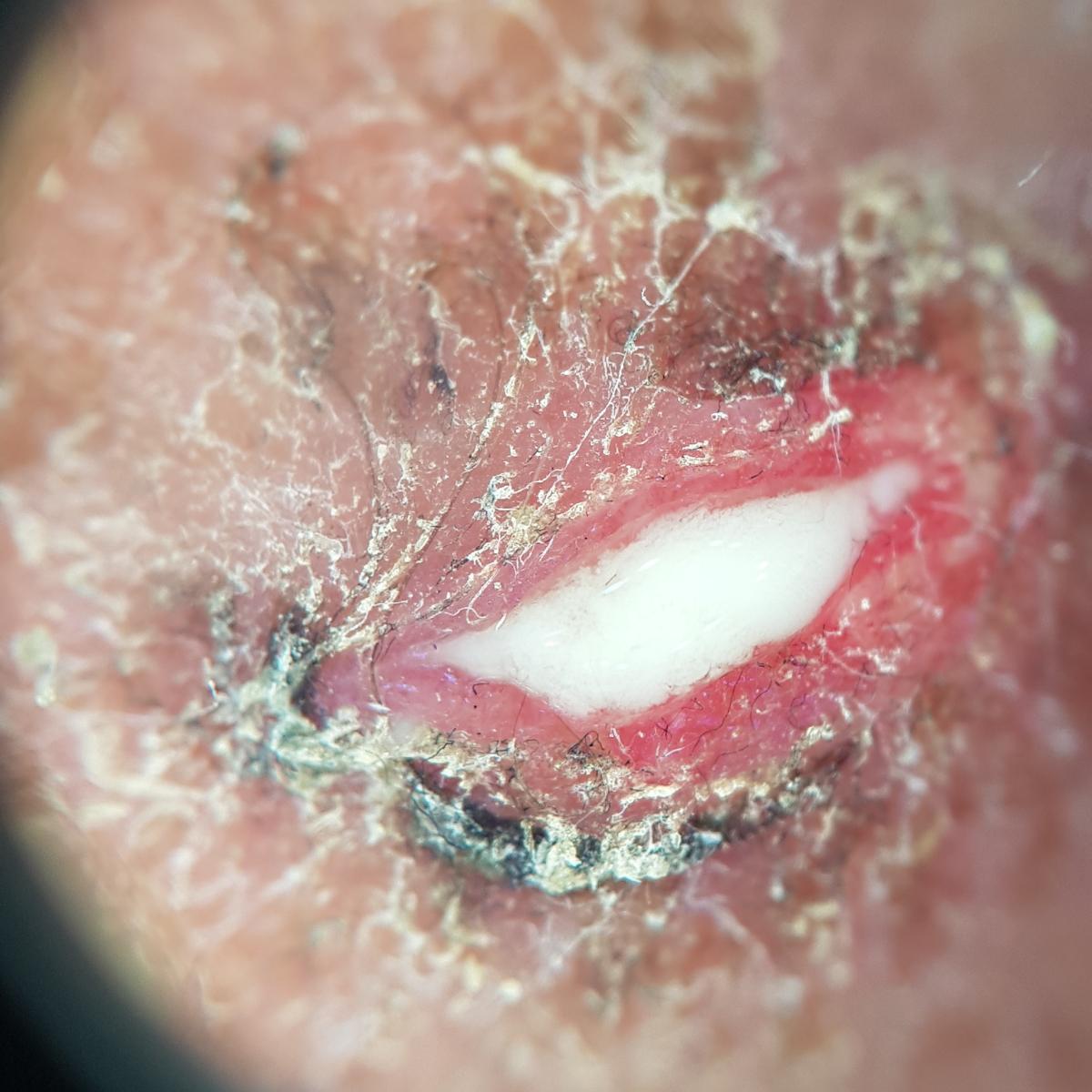 гонорея гонорея