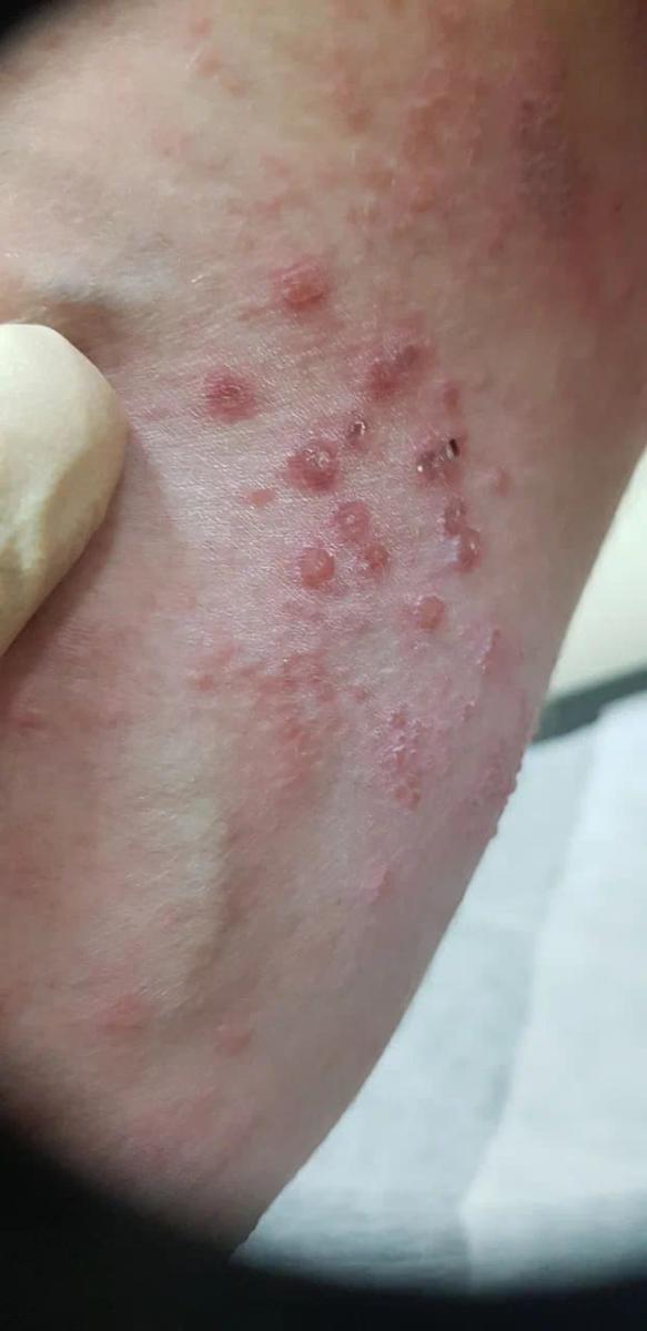 Опоясывающий герпес Опоясывающий герпес