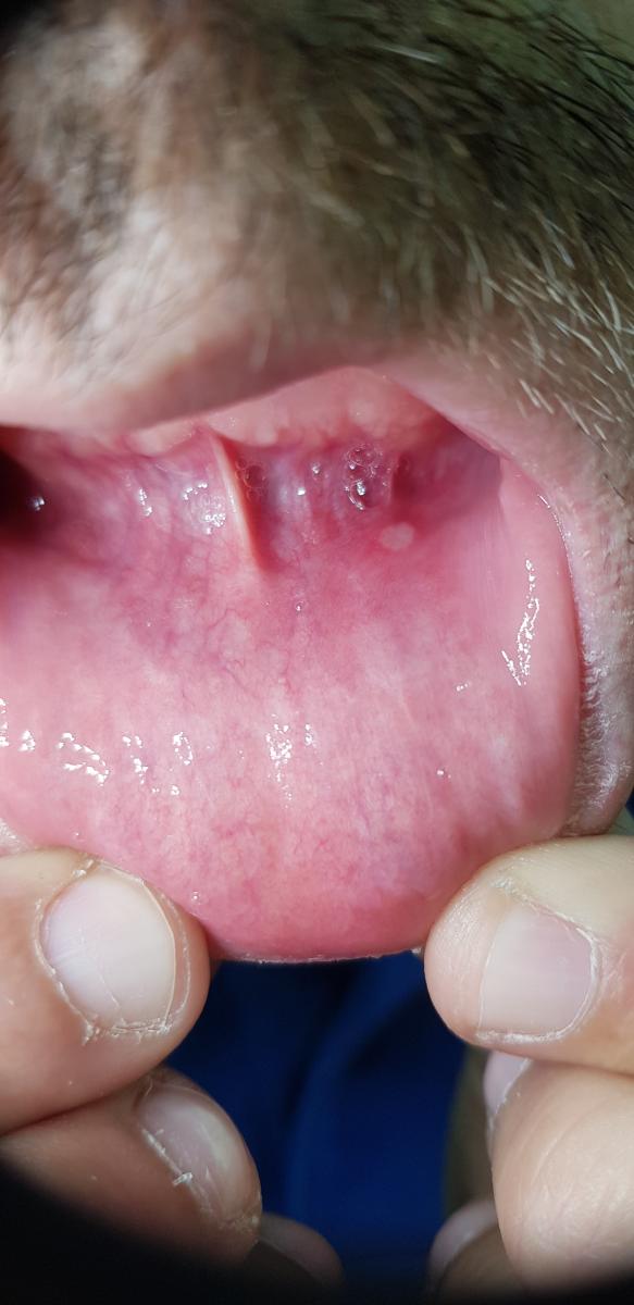 герпес герпес