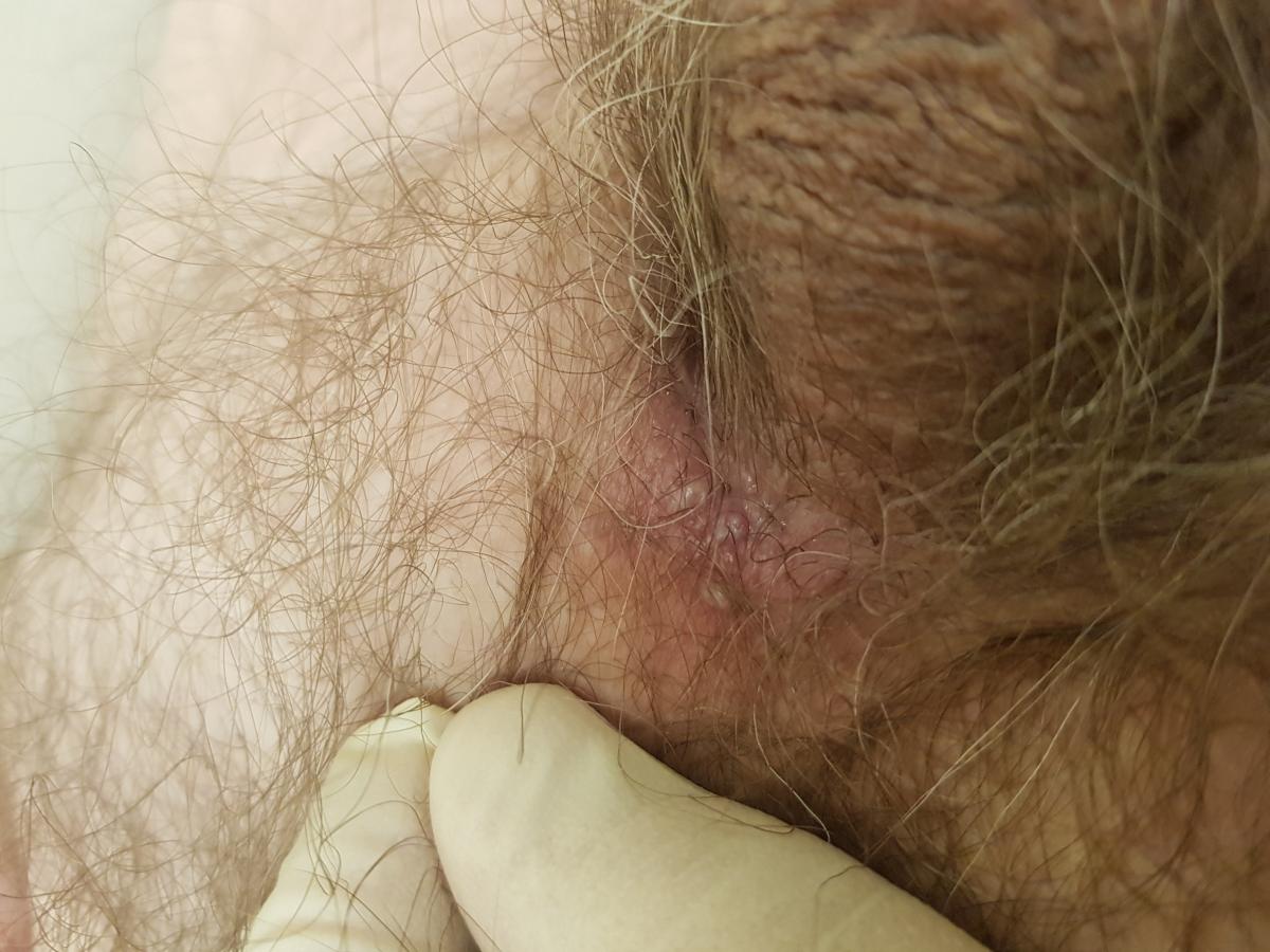 герпетические высыпания герпес на лобке