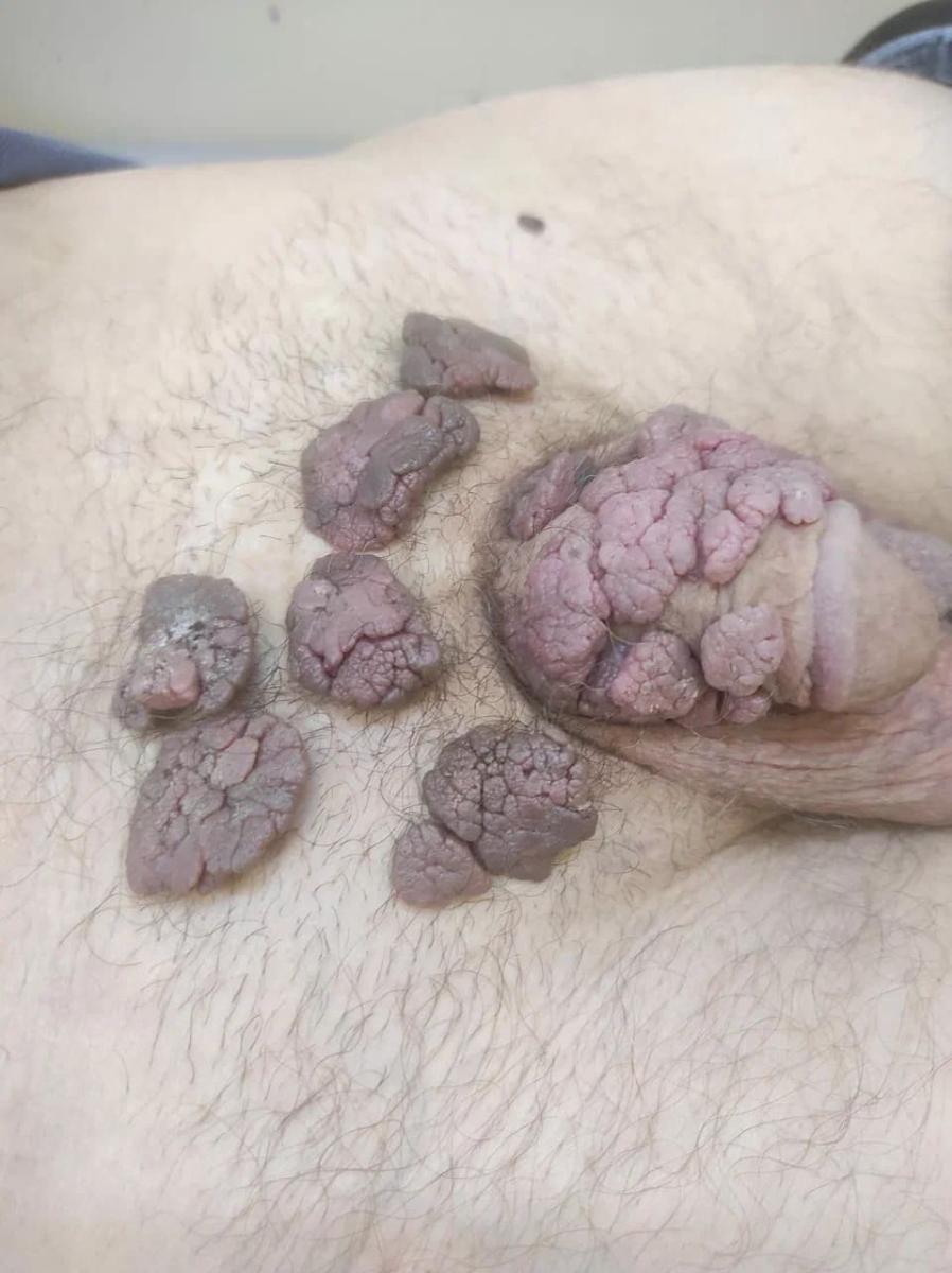 Лимфотропное введение Гигантские кондиломы