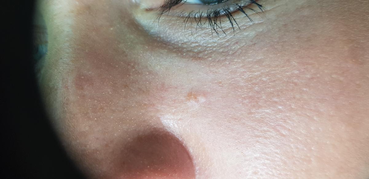  лопается кожный покров