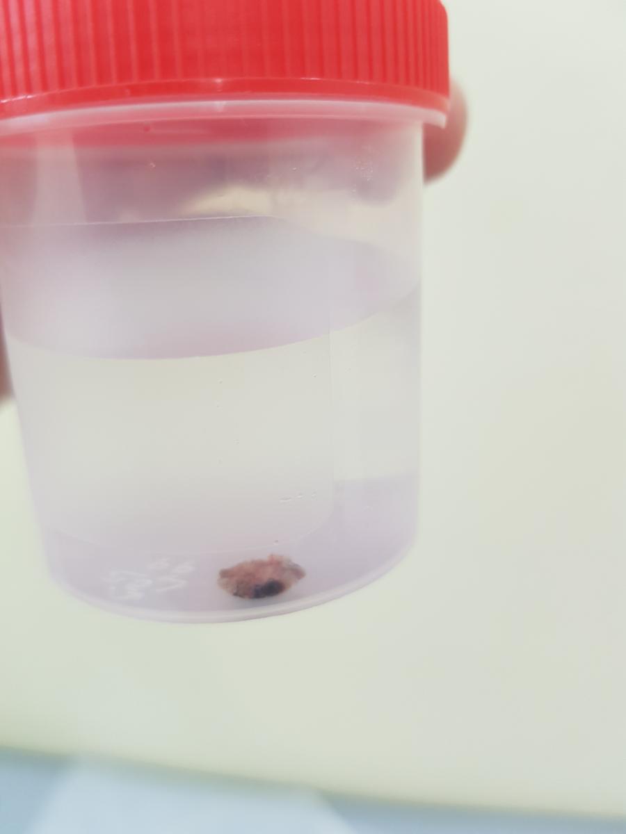 процедура кольпоскопии