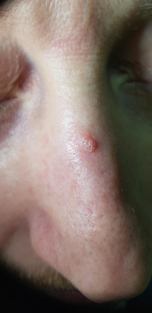 ппризнаки сифилиса 