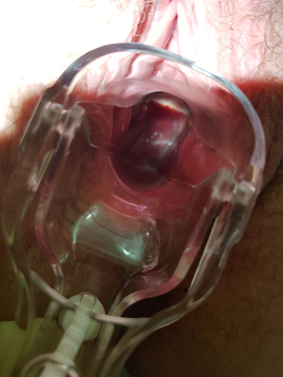 Мазок на флору может обнаружить гарднереллу