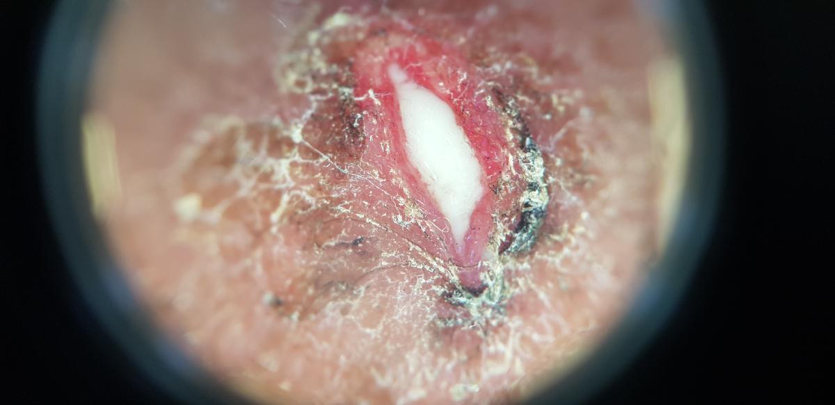 ЗППП, которые вызывают гнойный простатит