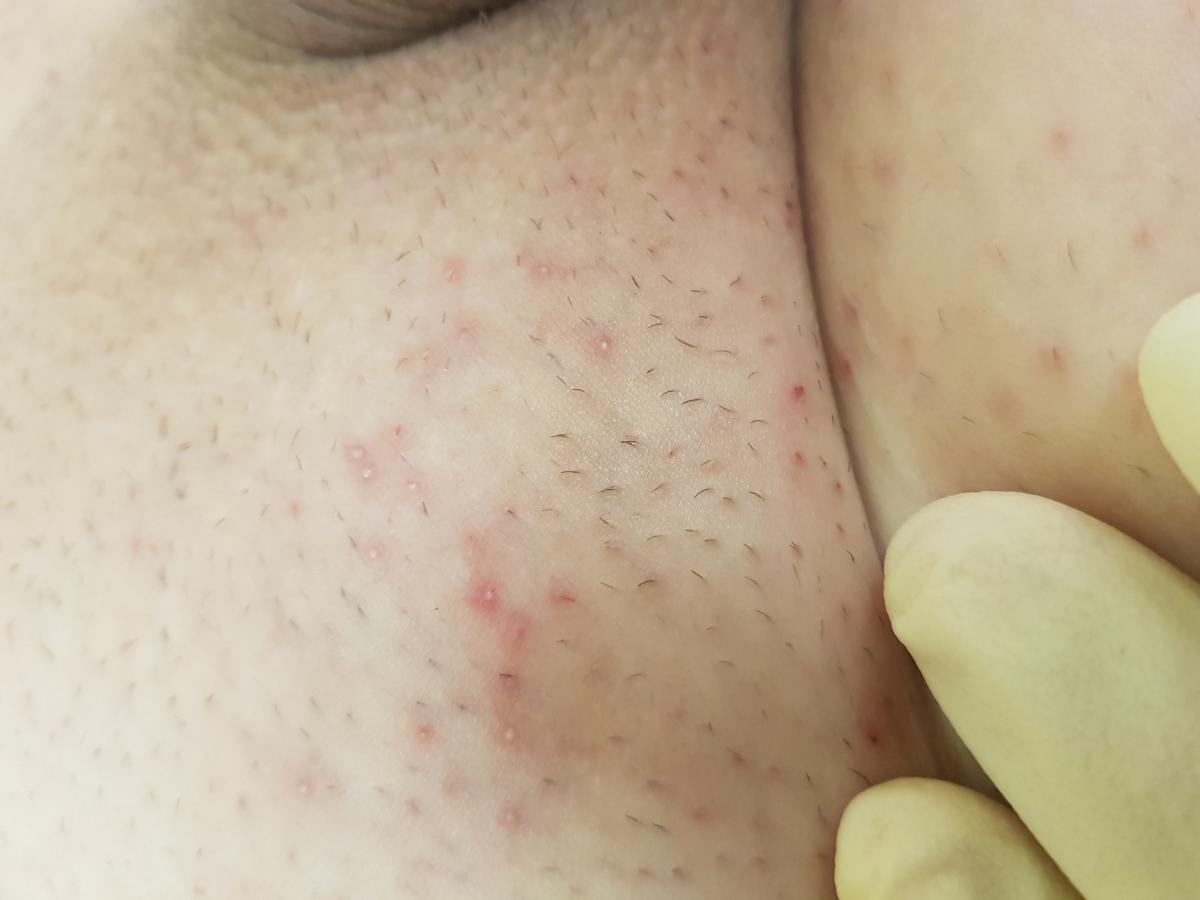 хронический фолликулит на лобке фолликулит