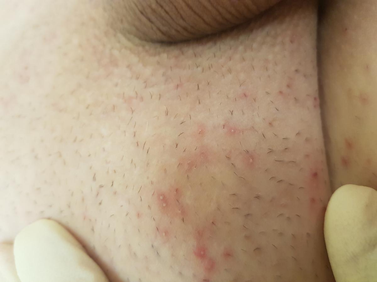 хронический фолликулит на лобке Хронический фолликулит