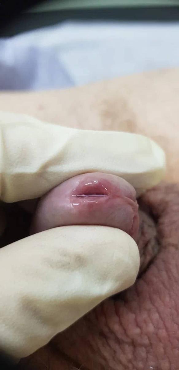 хронический уретрит