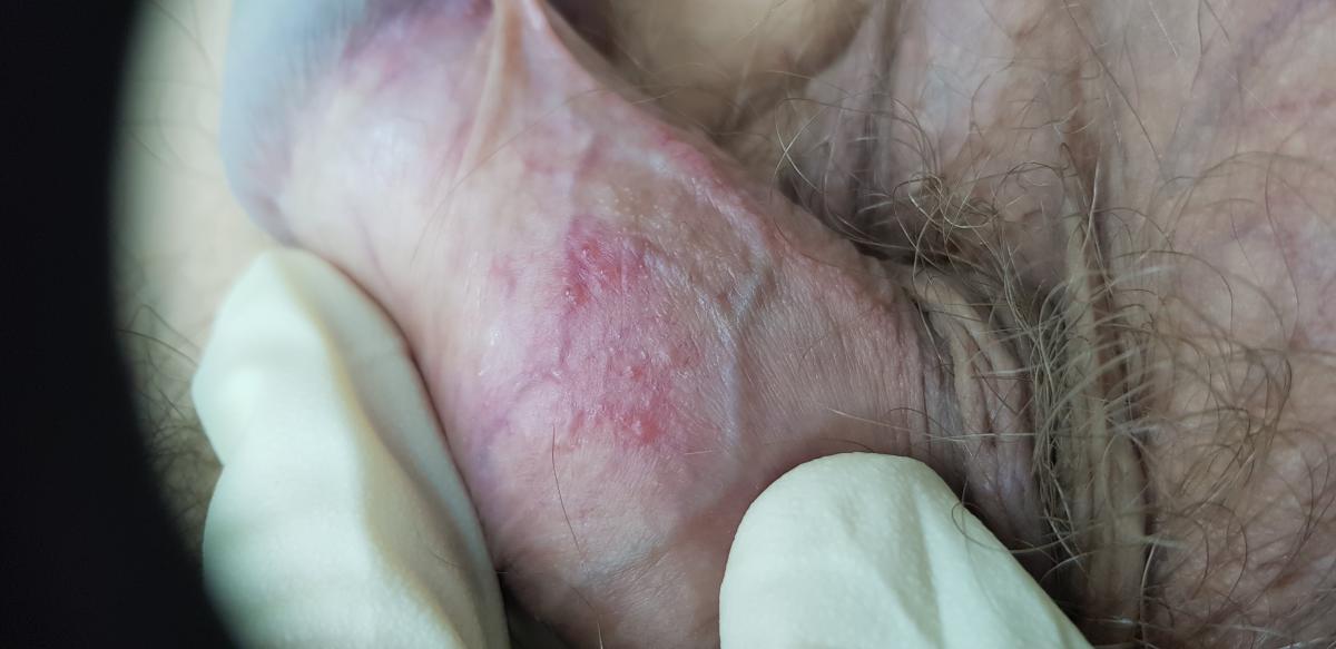 Половой герпес у мужчин и женщин