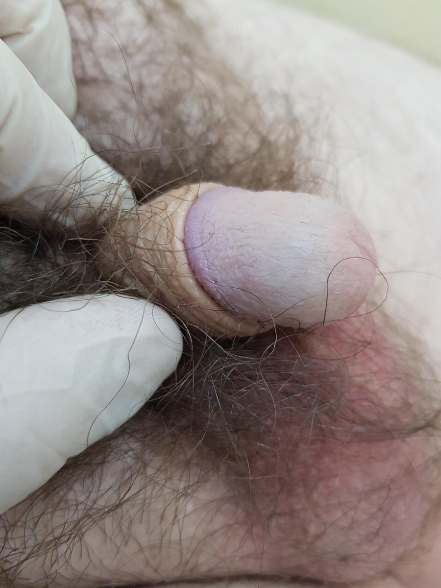 Расстройства мужской половой сферы