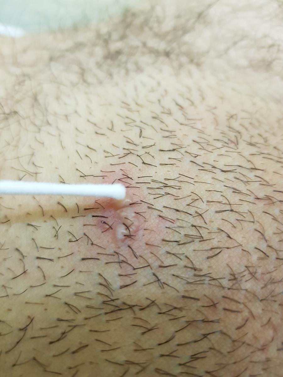 ПЦР диагностика ЗПП