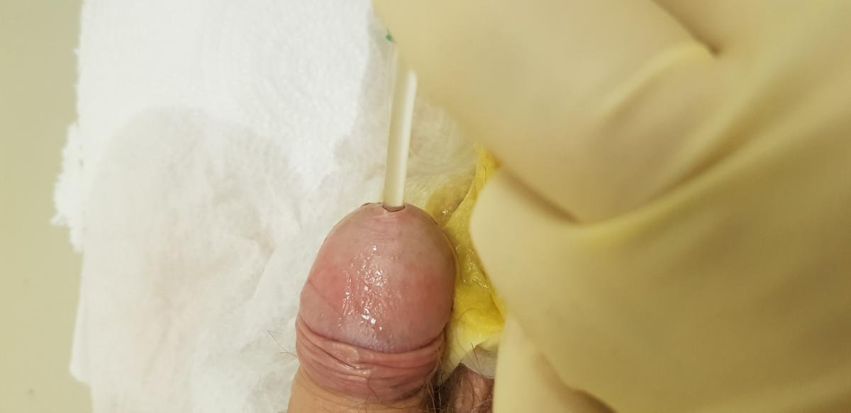 инстилляция в уретру инстилляция