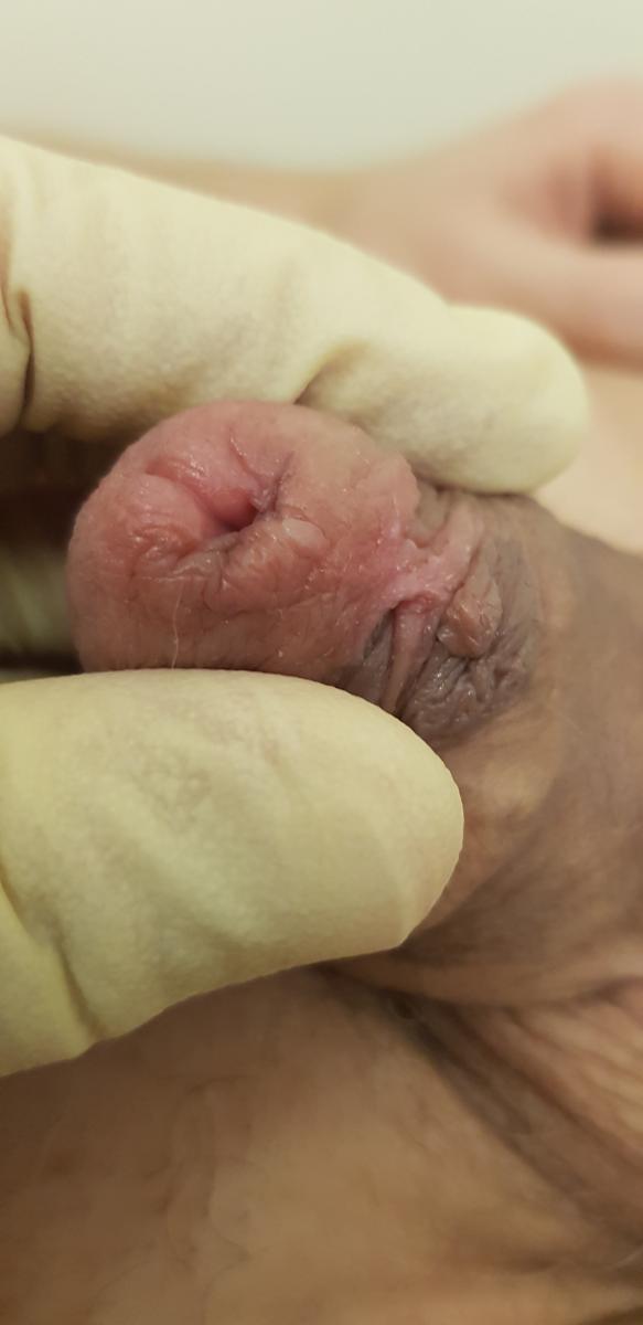 Искривление губок уретры 