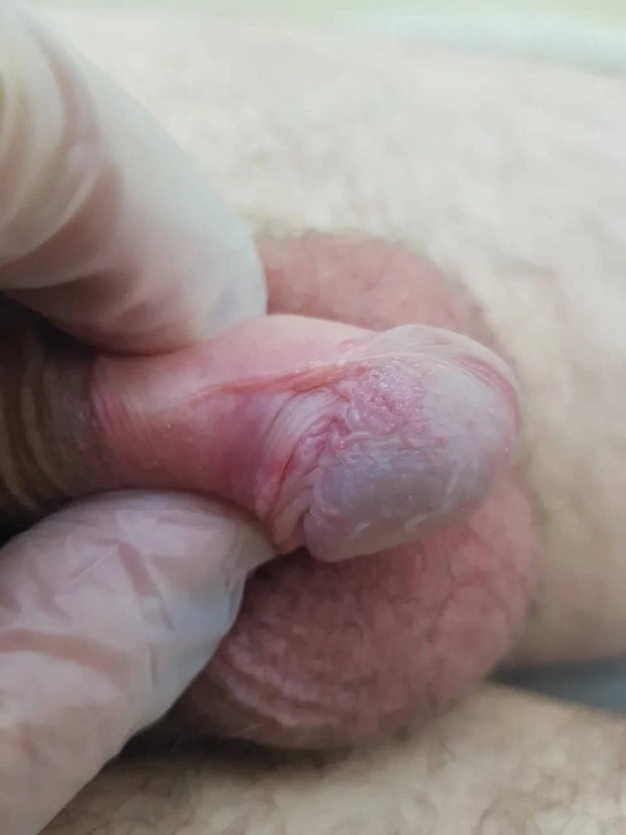 кандида и пиогенный стрептококк