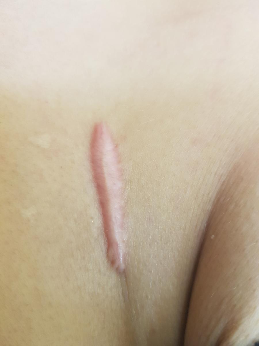 рубец келоидного типа