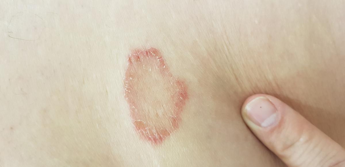 кольцевидная центробежная эритема Дарье эритема Дарье