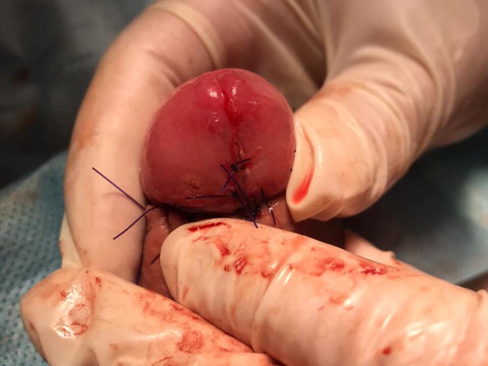 боли после удаления болит головка после удаления кондилом