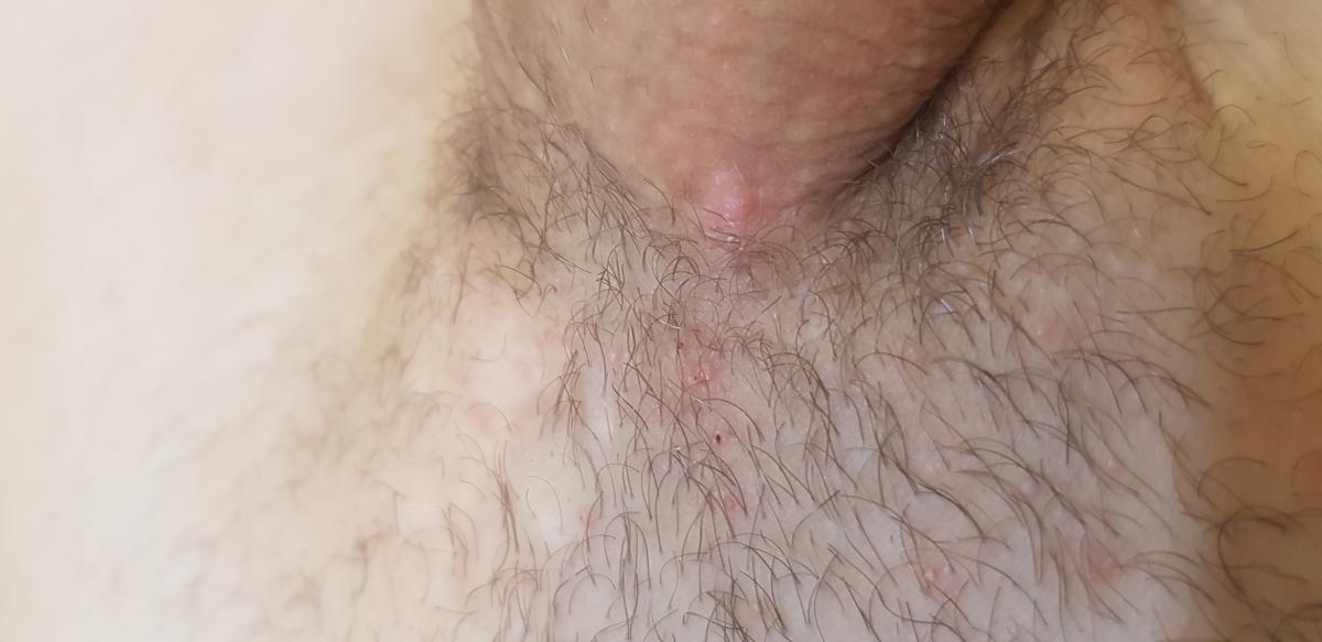 узелки в основании члена Узелки