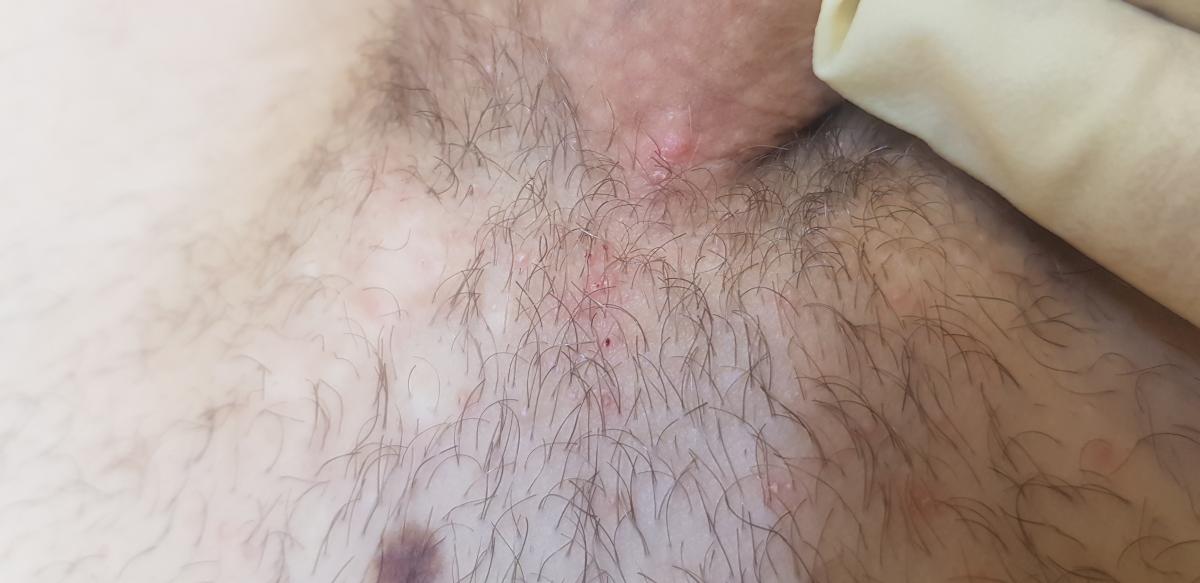 узелки в основании члена Узелки