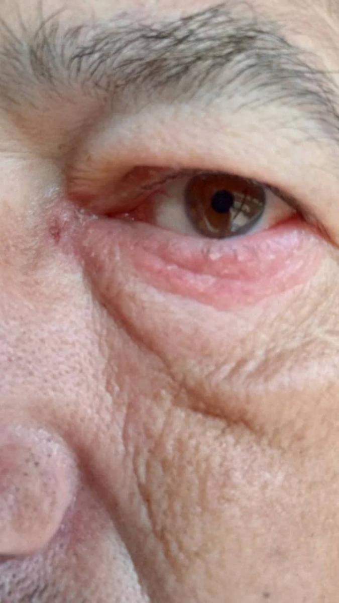 гонорейный конъюнктивит