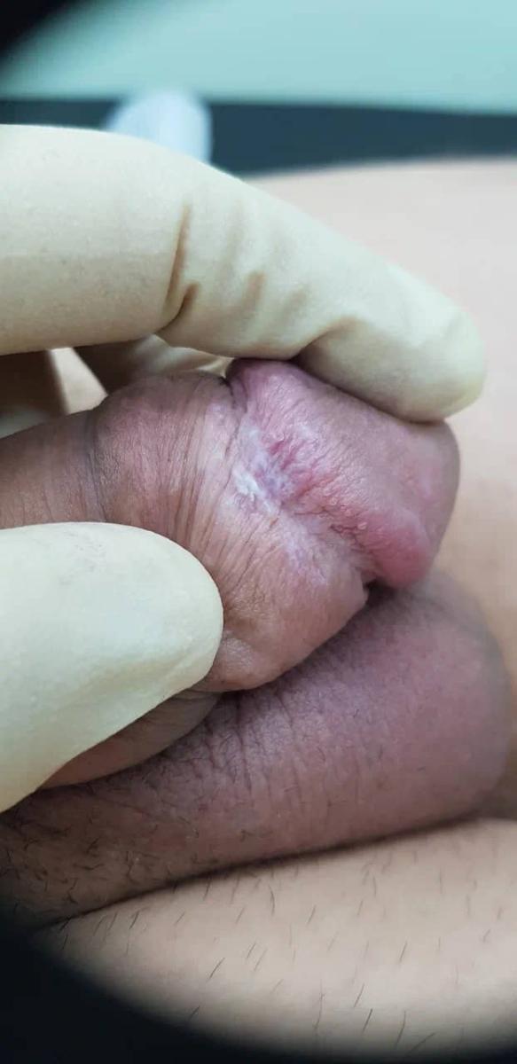 Красный плоский лишай