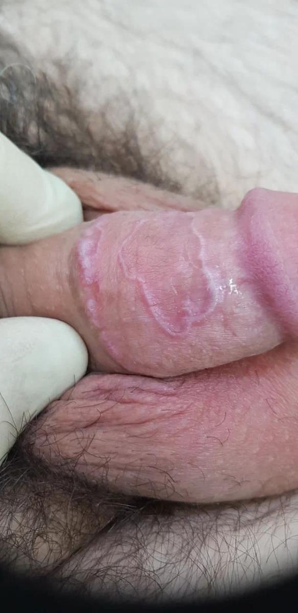 Красный плоский лишай