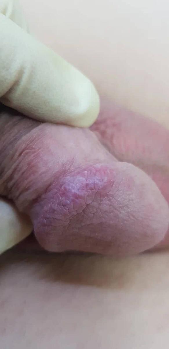 Красный плоский лишай