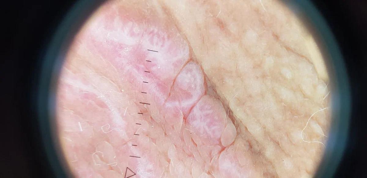 Красный плоский лишай