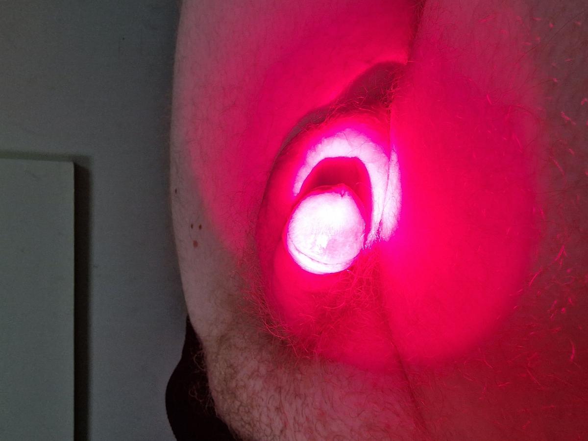 Лазерная терапия