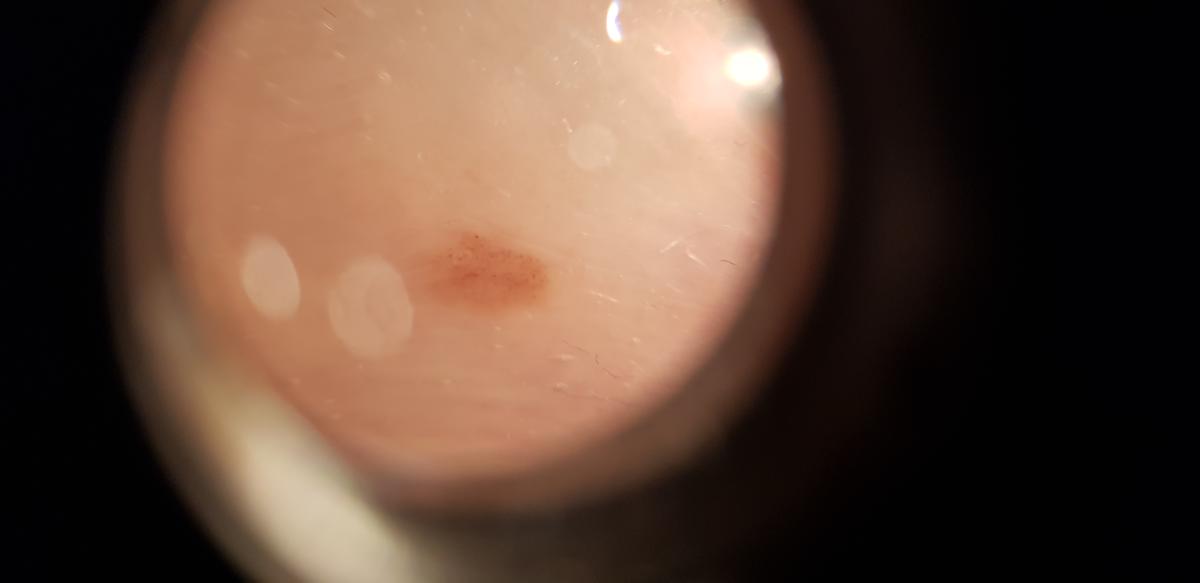 темное пятно на головке члена в дерматоскопе дерматоскоп