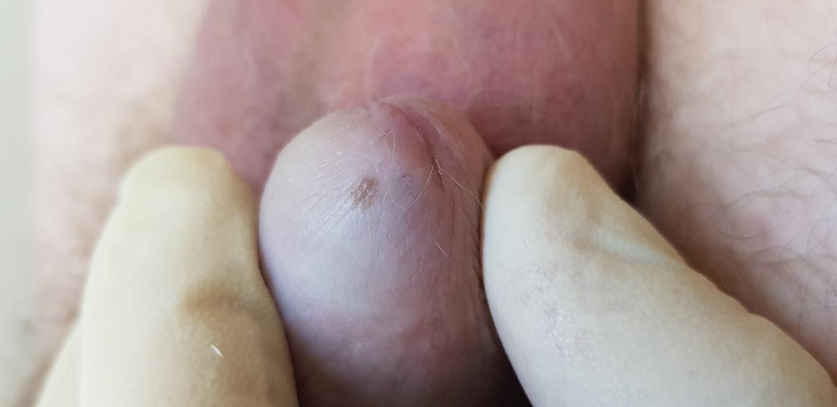 Темное пятно на головке члена Темное пятно