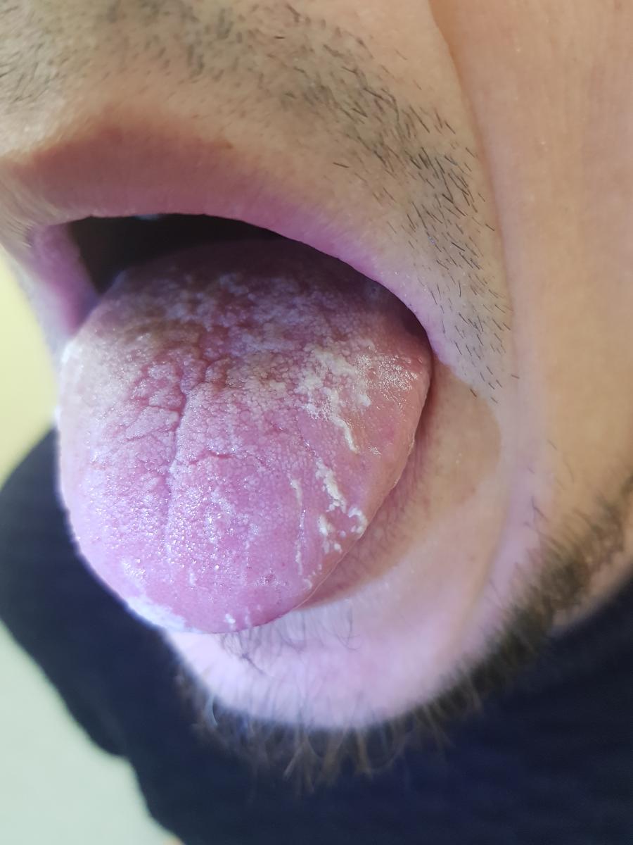 налет при кандиде