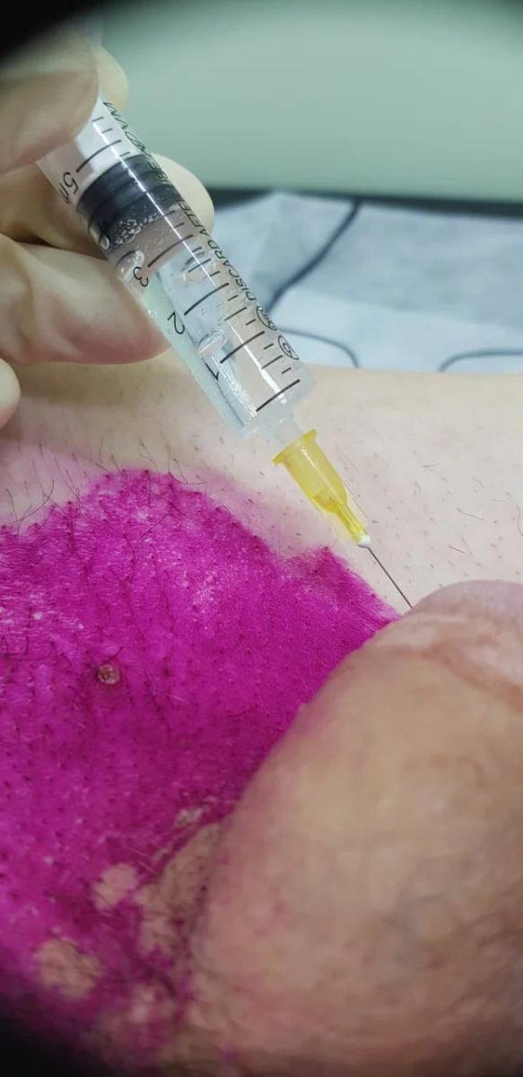 Лимфотропное введение